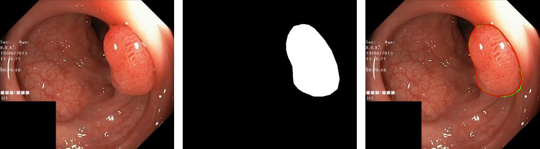 Colonoscopy frame, its ground-truth polyp mask, and the model's predicted outline overlaid on the frame